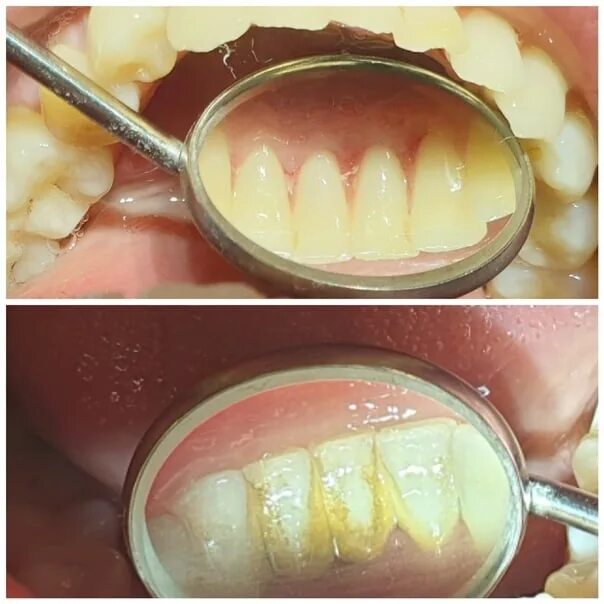 Пристли налет на зубах фото Комплексная аппаратная чистка зубов 2022 Стоматологический кабинет "ВАУ-Дент" Ма