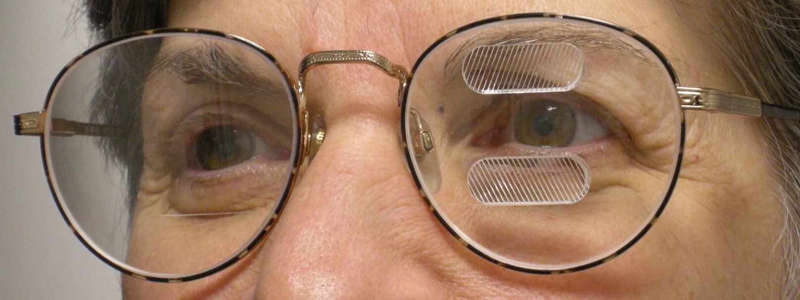 Призматические очки фото Peripheral prism glasses help hemianopia patients get around