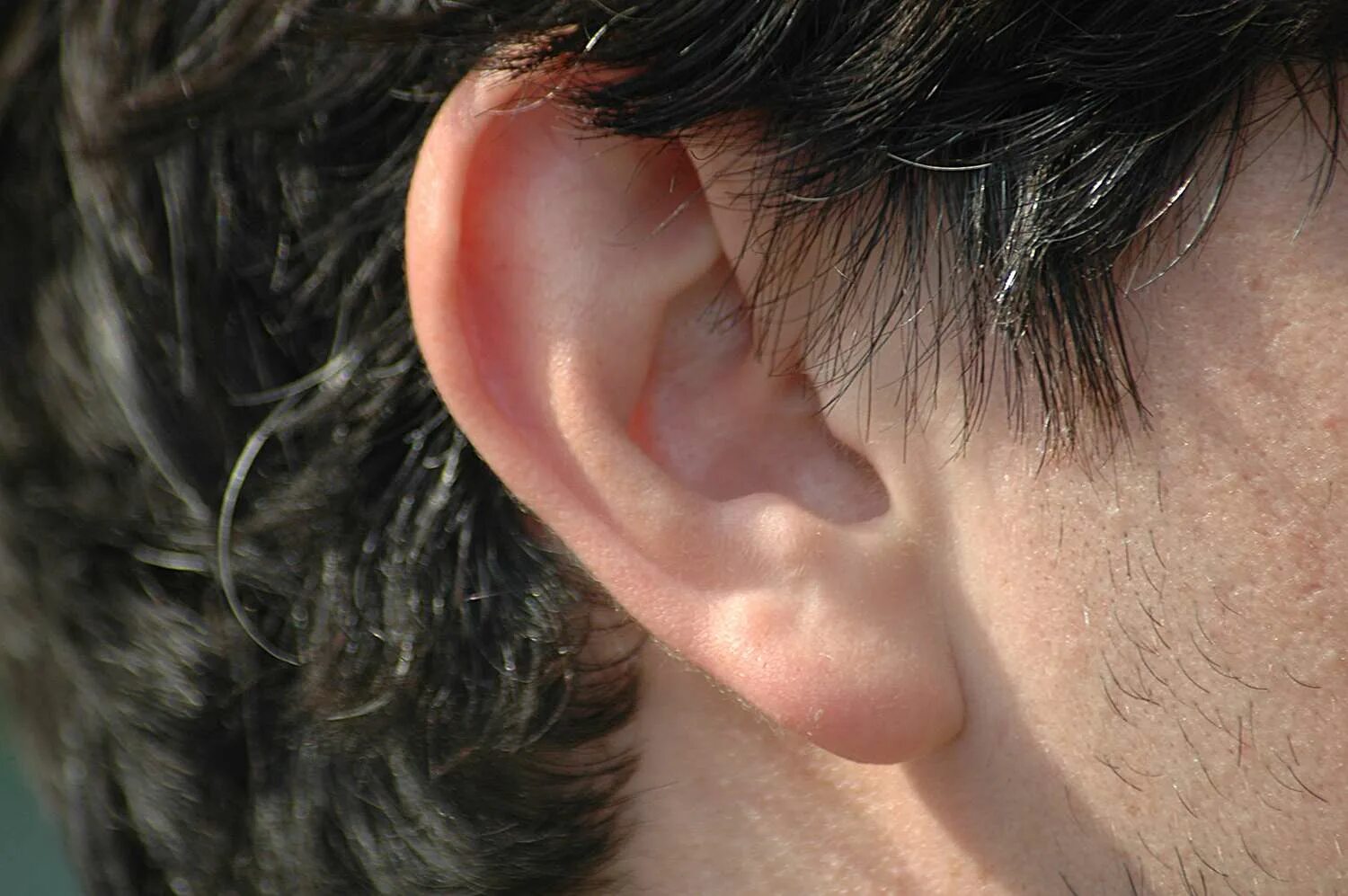 Признак франка на мочке уха фото Earlobe: Anatomy and Associated Conditions