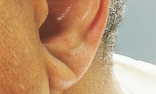 Признак франка на мочке уха фото Ear lobe crease is tell-tale sign of a stroke