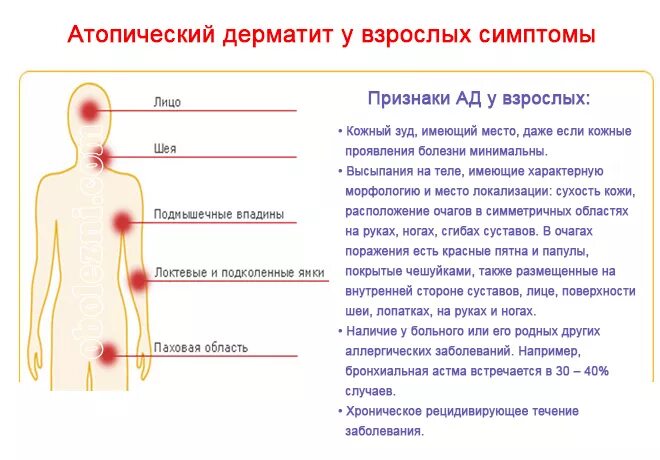 Признаки аллергического дерматита у взрослых фото Солнечный дерматит у взрослых: причины, симптомы, диагностика и лечение мазями и