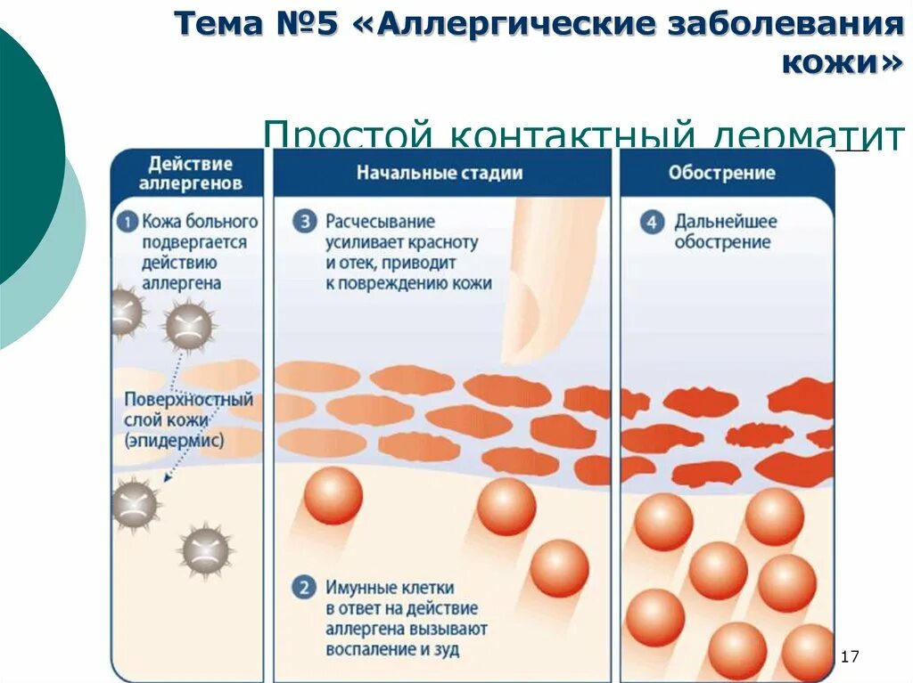 Признаки аллергического дерматита у взрослых фото Атопический дерматит время возникновения зуда: найдено 79 изображений