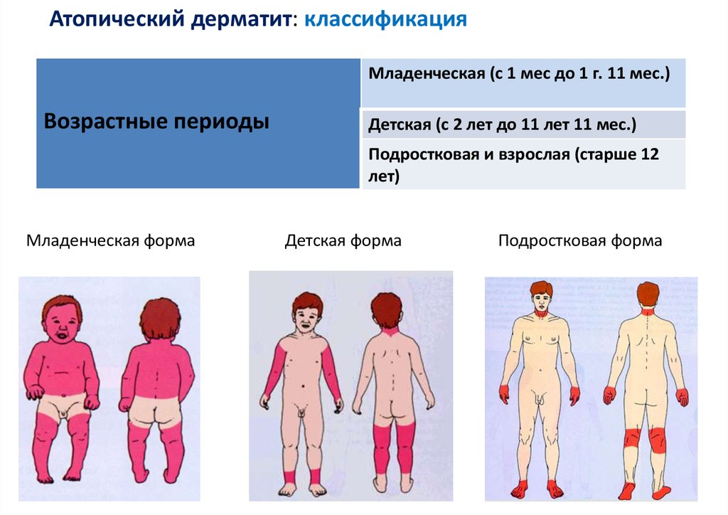 Клинические формы атопического дерматита