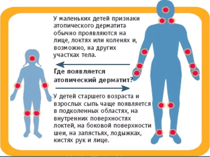 Признаки атопического дерматита у взрослых фото Атопический дерматит у детей: причины, симптомы, методики лечения - медикаментоз