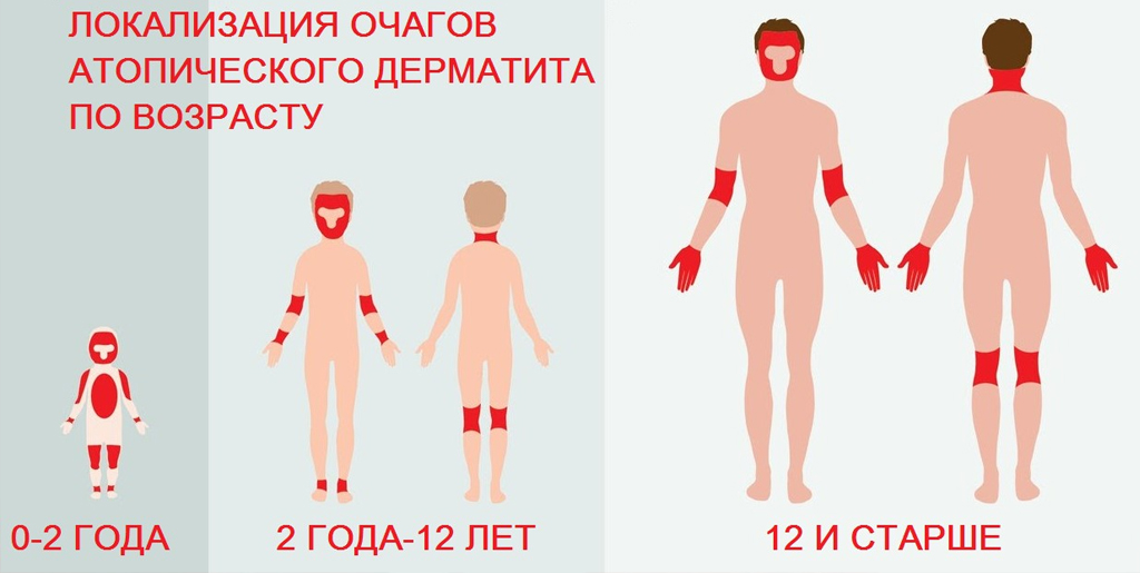 Атопический дерматит: заболевания кожи: диагностика, лечение, профилактика