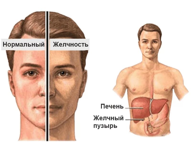 Признаки болезни печени на лице фото О циррозе печени и его осложнениях простыми словами Владимир Шиповский