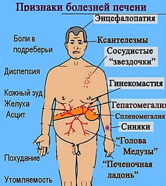 Признаки болезни печени на лице фото Картинки ЦИРРОЗ ПРИЗНАКИ У МУЖЧИН ПЕРВЫЕ СИМПТОМЫ