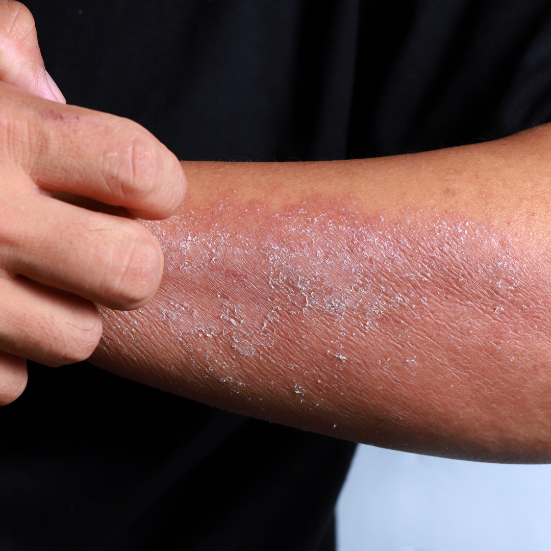 Признаки дерматита фото Eczema: Who is Affected and What You Need to Know Sanova Dermatology