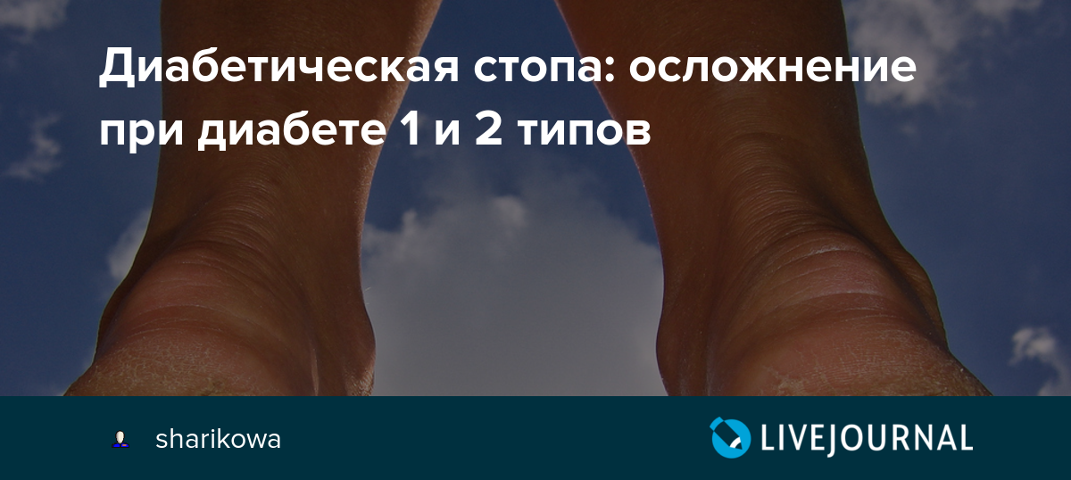 Признаки диабетической стопы фото симптомы Диабетическая Стопа У Женщин Фото И Описание - Karevaphoto.ru