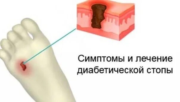 Признаки диабетической стопы фото симптомы Добрый день .Хочется затронуть случай который встречается в нашем кабинете и кон