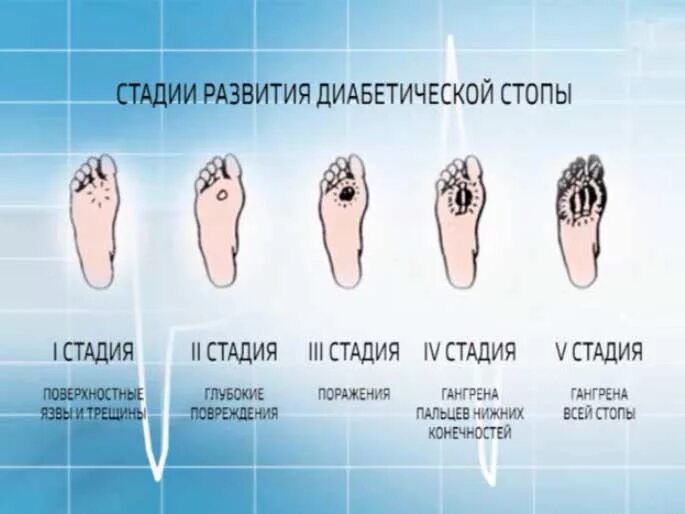 Признаки диабетической стопы фото симптомы Дорога к доктору. Лечение диабетической стопы