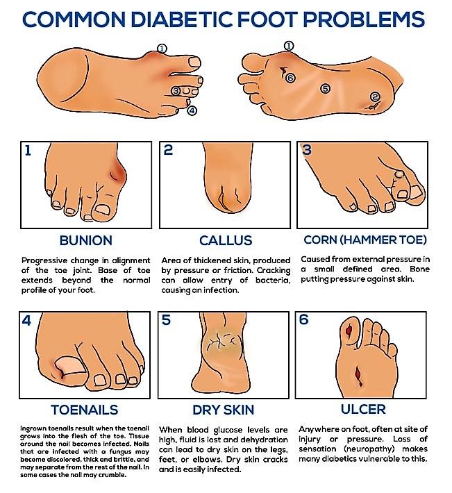 Признаки диабетической стопы фото симптомы Pin on Disease