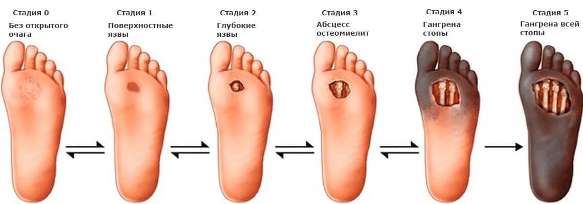 Признаки диабетической стопы фото симптомы Диабетическая стопа: причины, симптомы, виды, лечение, когда нужна ампутация, ка