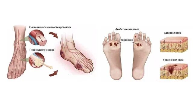 Признаки диабетической стопы фото симптомы Диабетическая стопа: признаки и симптомы, как развивается, лечение синдрома при 