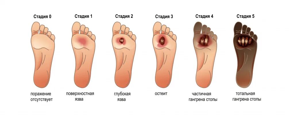 Признаки диабетической стопы фото симптомы Диабетическая стопа (синдром диабетической стопы) - симптомы острой и хроническо