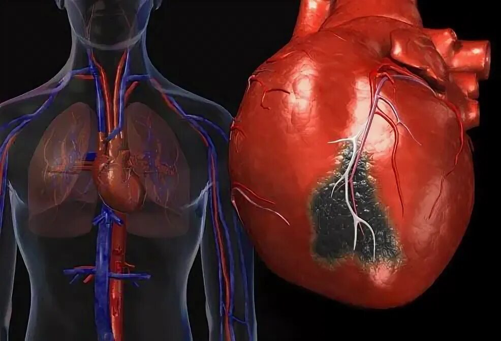 Признаки фото сердца A Visual Guide to Heart Disease Ataque cardiaco, Cardiovascular, Ervas curativas