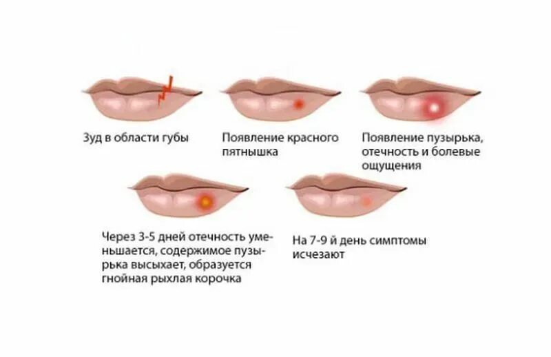 Признаки герпеса фото Чем быстро вылечить герпес на губах