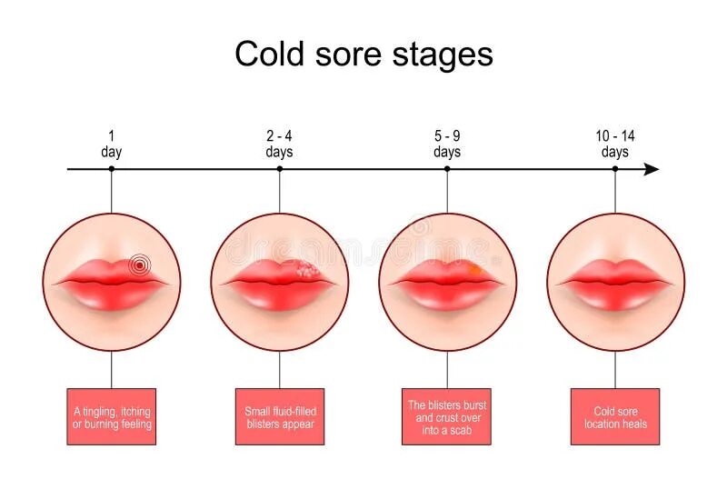 Признаки герпеса фото Lips Herpes Cold Sore Inflammation Vector Icon. Labial Herpes Simplex Infection 