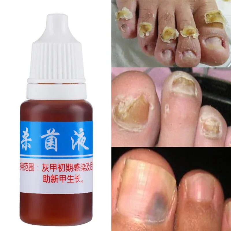 Признаки грибка ногтей фото 10ml Toe Nail Fungus Treatment Kills 99.9% Bacteria Anti Fungal Nail Infection R