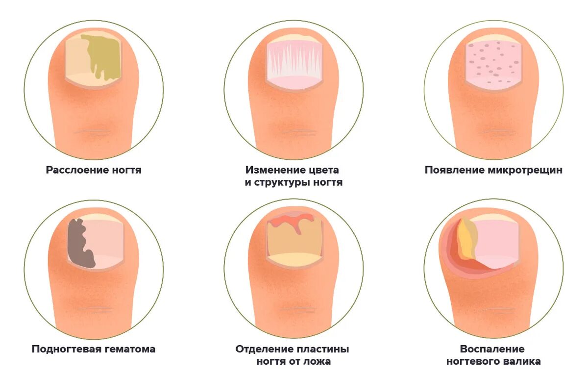 Признаки грибка ногтей фото Посмотрите на свои ногти: вот что можно по их изменениям сказать о вашем здоровь