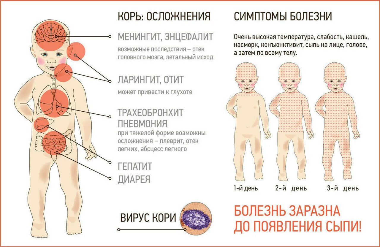 Признаки кори симптомы взрослых фото Симптомы кори признаки лечение - найдено 88 фото