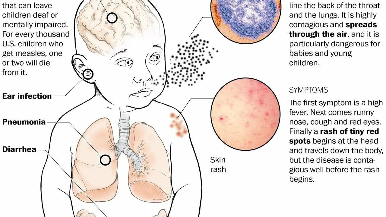 Признаки кори симптомы взрослых фото Can You Die From Measles? Tita TV - YouTube