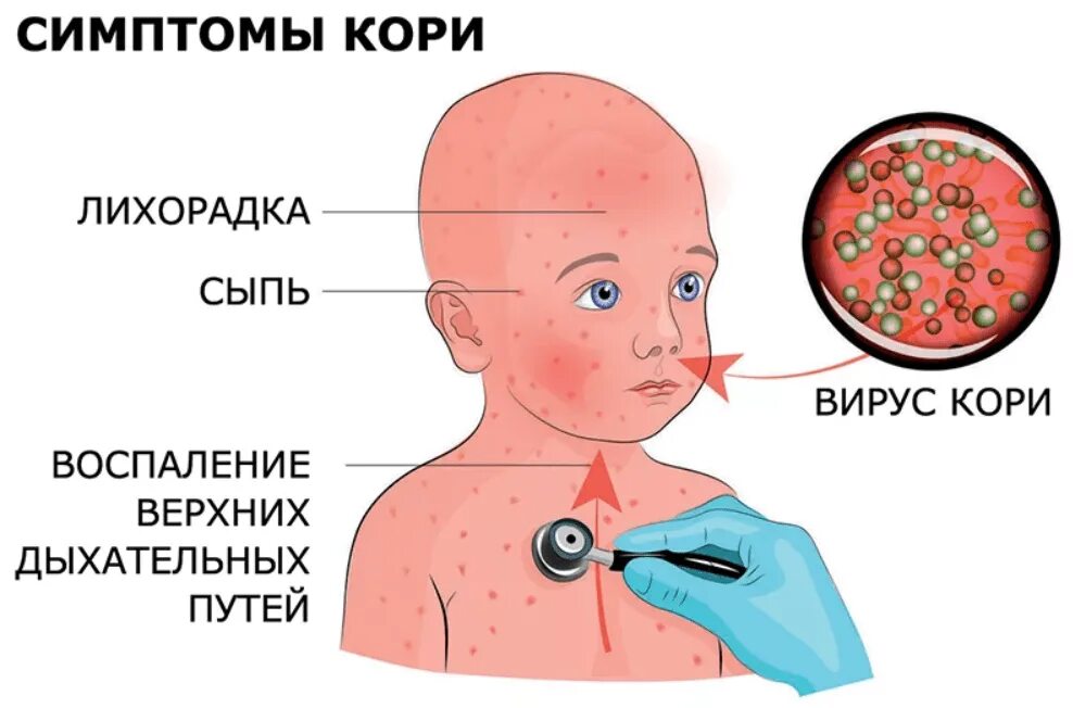 Признаки кори симптомы взрослых фото Корь и меры её профилактики