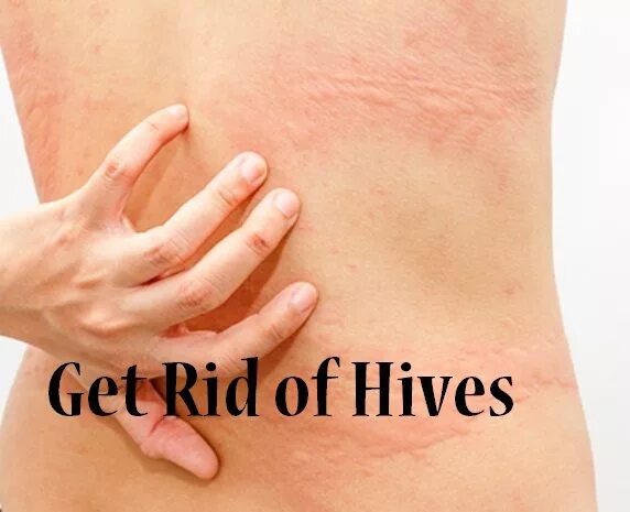 Признаки крапивницы у взрослых фото симптомы How to Get Rid of Hives? Hives, How to get rid, Home treatment