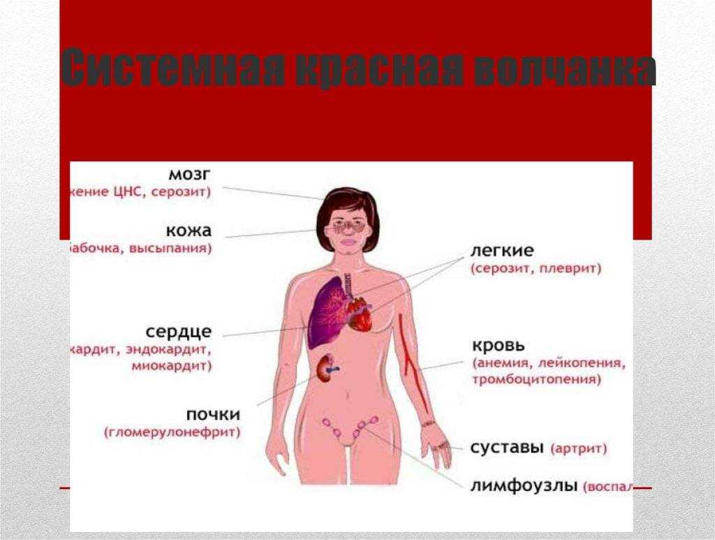 Признаки красной волчанки у женщин фото Красная волчанка симптомы у женщин после 50 - CollectPhoto.ru