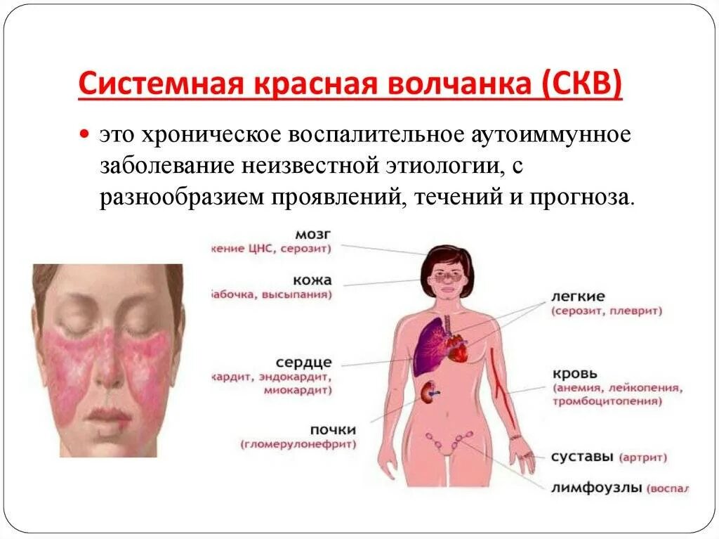 Признаки красной волчанки у женщин фото Картинки СИСТЕМНАЯ КРАСНАЯ ВОЛЧАНКА ОТНОСИТСЯ