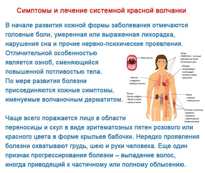 Признаки красной волчанки у женщин фото Анализ симптомов болезни