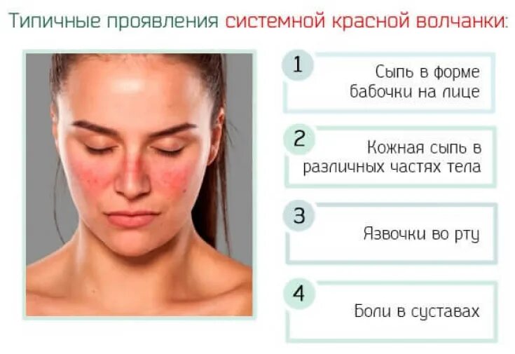 Признаки красной волчанки у женщин фото Skin lesions in systemic lupus erythematosus - Estet-Portal