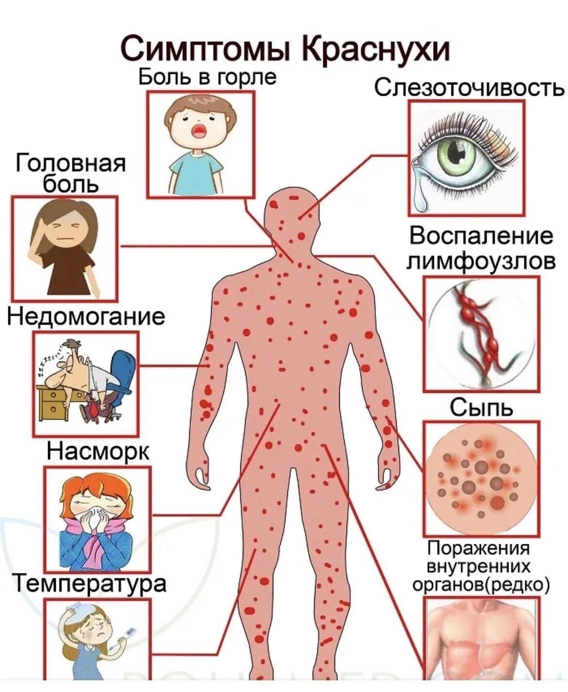 Признаки краснухи у взрослых фото симптомы Краснуха - симптомы и лечение - РКЦИБ Грозный