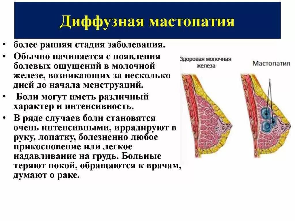 Признаки мастопатии у женщин симптомы фото Что такое мастопатия молочной железы: симптомы и признаки у женщин