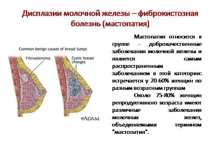 Признаки мастопатии у женщин симптомы фото Структура ткани железисто фиброзная