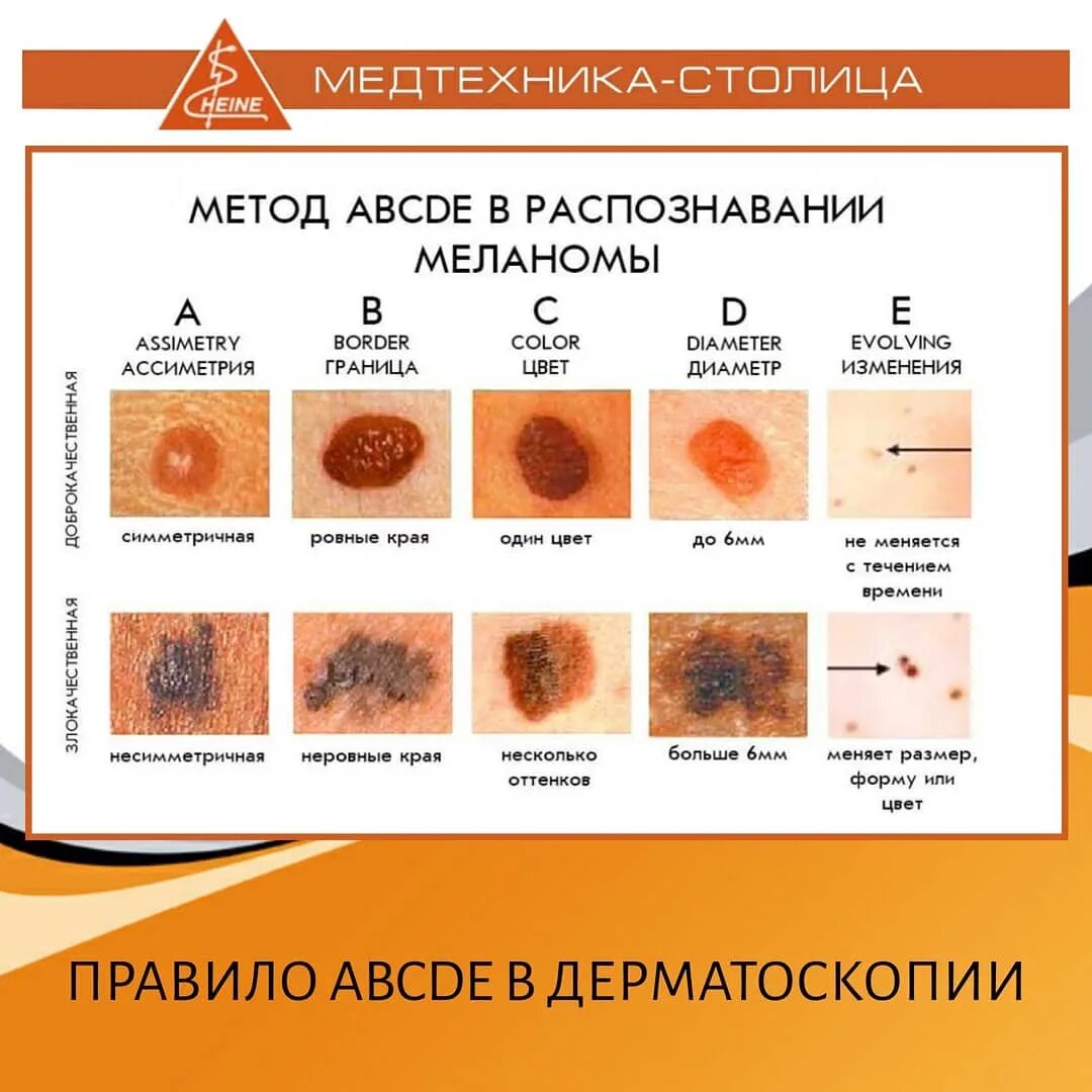 Признаки меланомы кожи у человека симптомы фото Где можно проверить родинку на онкологию: найдено 88 изображений