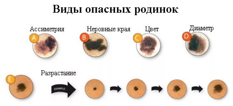 Признаки меланомы кожи у человека симптомы фото Удаление родинок по доступной цене в Подольске