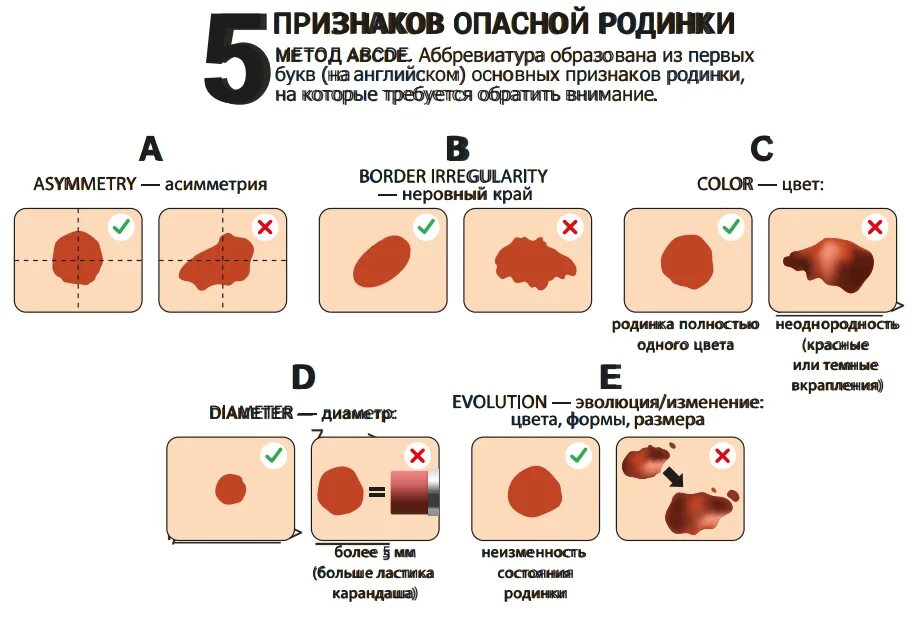 Признаки меланомы кожи у человека симптомы фото Опасные родинки, как отличить и что делать. Арклиник Дзен