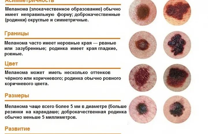 Признаки меланомы кожи у человека симптомы фото Новости