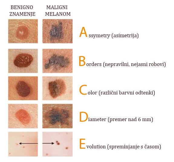 Признаки меланомы кожи у человека симптомы фото Najpogostejše oblike raka v Sloveniji in kako jih prepoznamo - Slovenec
