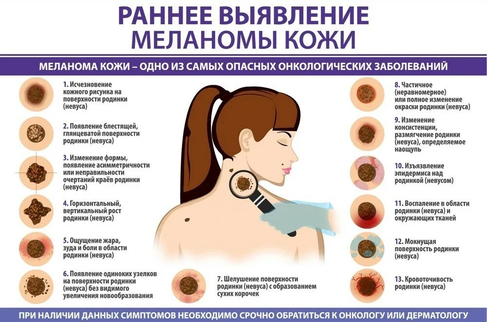 Признаки меланомы кожи у человека симптомы фото Городская поликлиника № 12 - Меланома