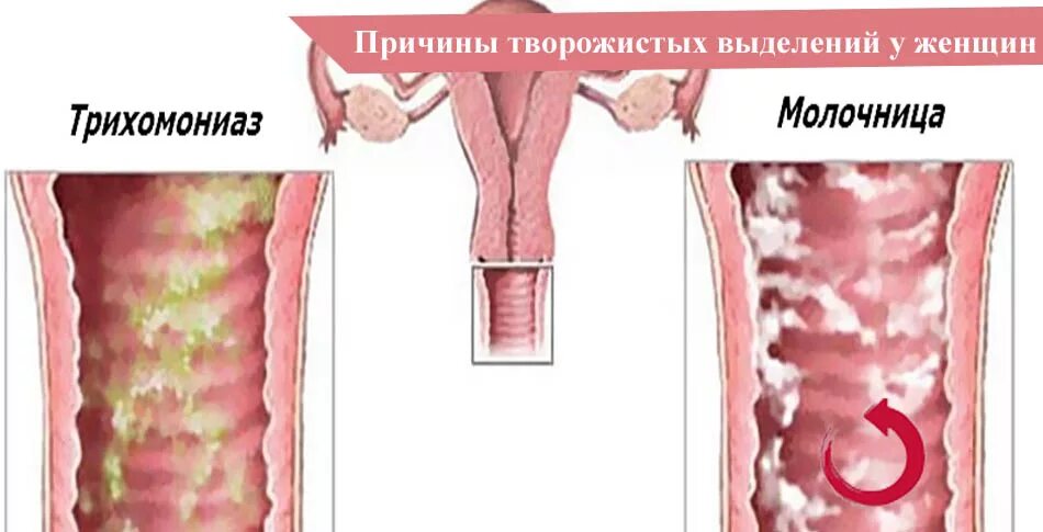 Признаки молочницы у мужчин симптомы фото Творожистые Выделения У Женщин, Виды, Причины, Лечение