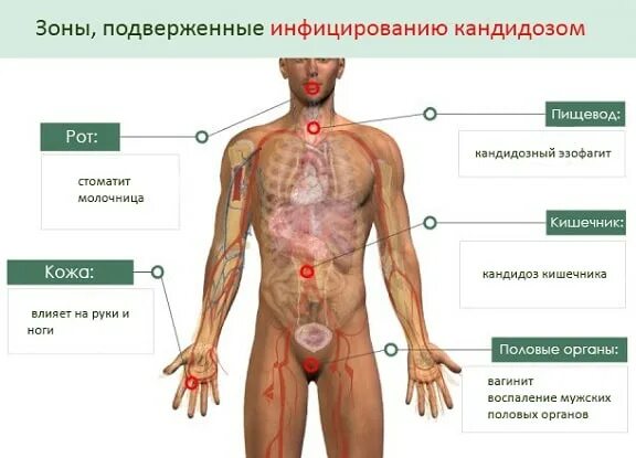 Признаки молочницы у мужчин симптомы фото Можно ли забеременеть при кандидозе: особенности процесса