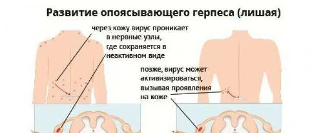 Признаки опоясывающего лишая у человека фото Картинки ОПОЯСЫВАЮЩИЙ ГЕРПЕС НЕВРАЛГИЯ ЛЕЧЕНИЕ