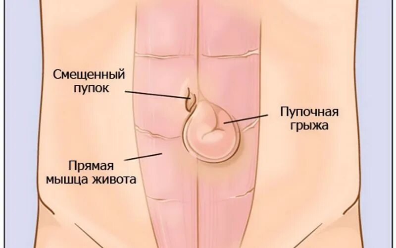 Признаки пупочной грыжи у женщин симптомы фото Faraway - Научные работы сотрудников МЗ Forum - Arizona RolePlay