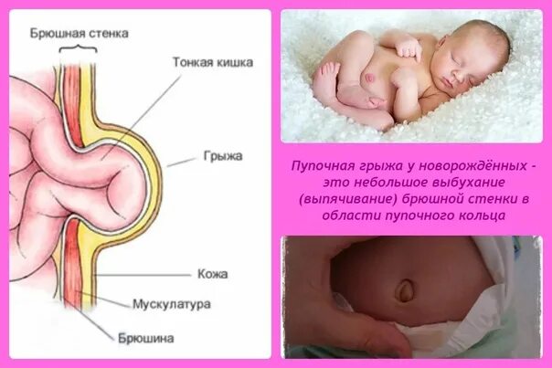 Признаки пупочной грыжи у женщин симптомы фото Hernia - protrusion of internal organs from the cavity in which they are located