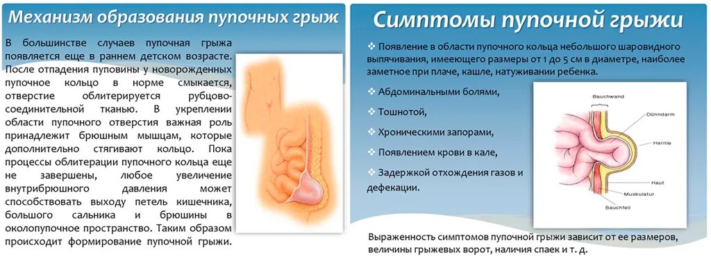 Признаки пупочной грыжи у женщин симптомы фото Пупочная грыжа у взрослых: причины, симптомы, лечение операцией