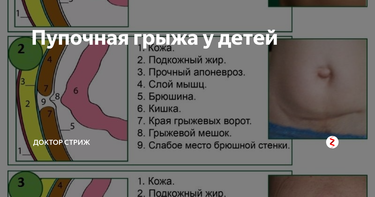 Признаки пупочной грыжи у женщин симптомы фото Пупочная грыжа у детей Доктор Стриж Дзен