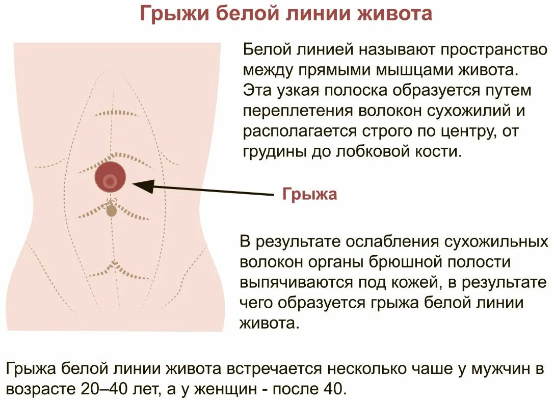 Признаки пупочной грыжи у женщин симптомы фото Грыжа живота: причины, симптомы, диагностика и лечение в статье хирурга Мнояна А