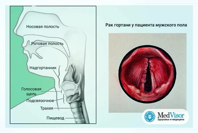 Признаки рака горла и гортани фото Какие симптомы у рака горла (гортани) medvisor.ru Дзен